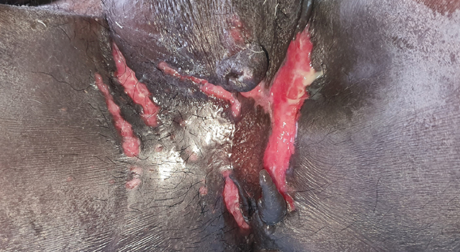 Knife-cut ulcers from Crohn's disease