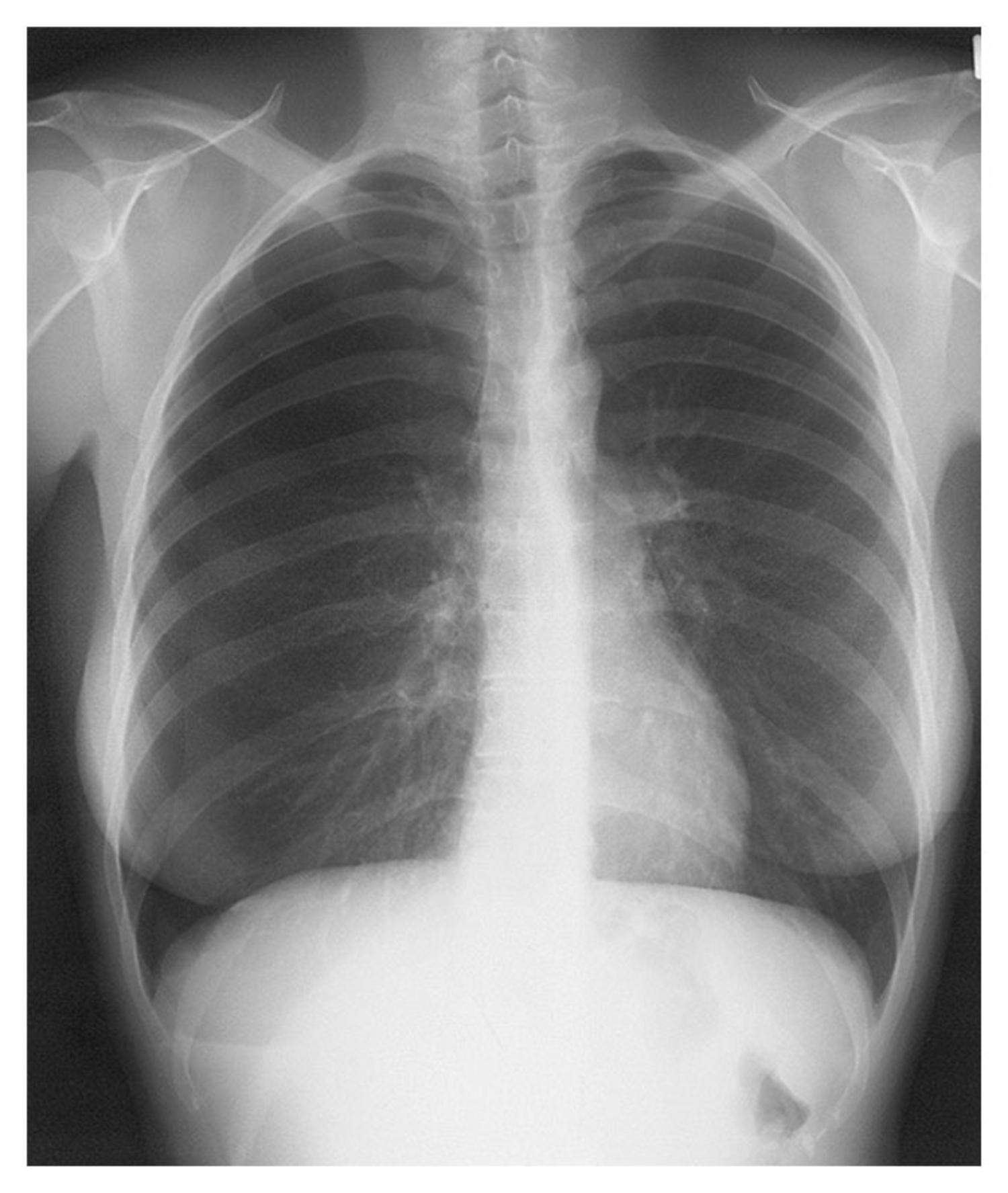 Thoracic endometriosis