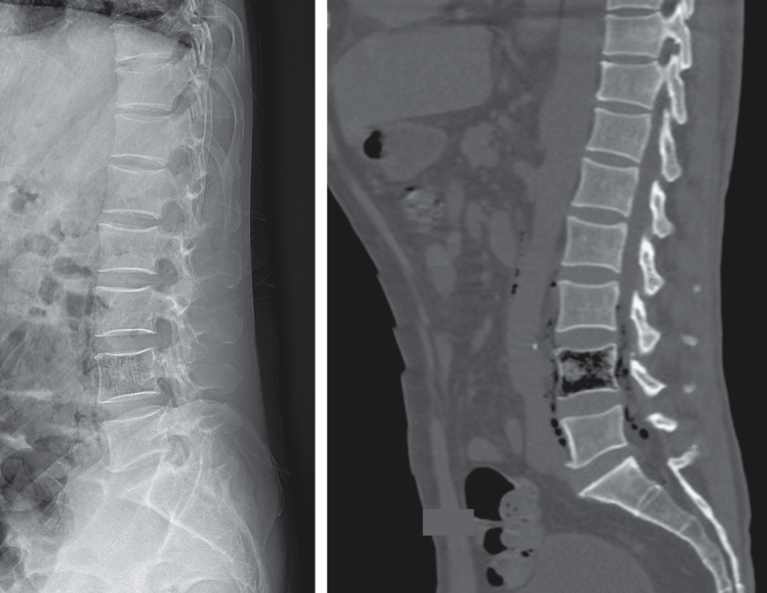Emphysematous osteomyelitis
