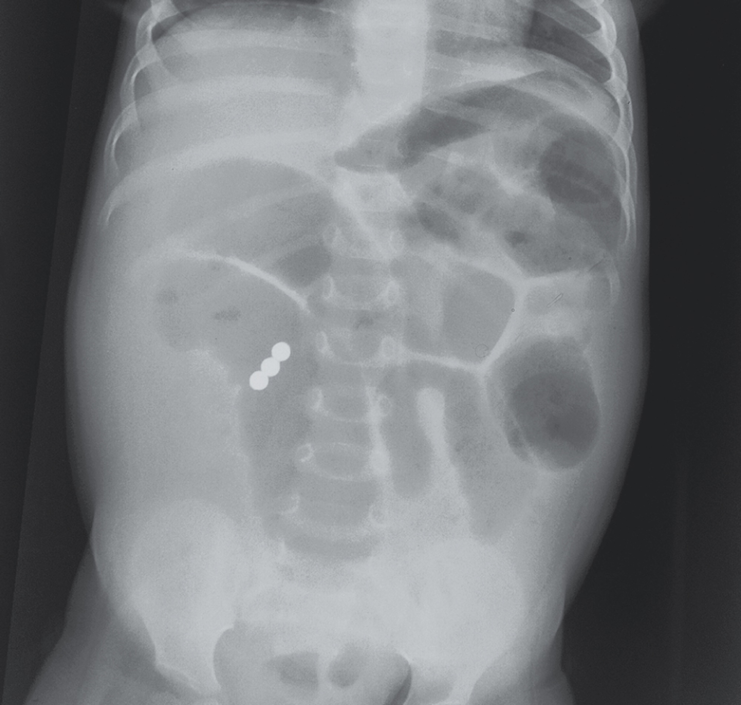 Emergency exploratory laparotomy