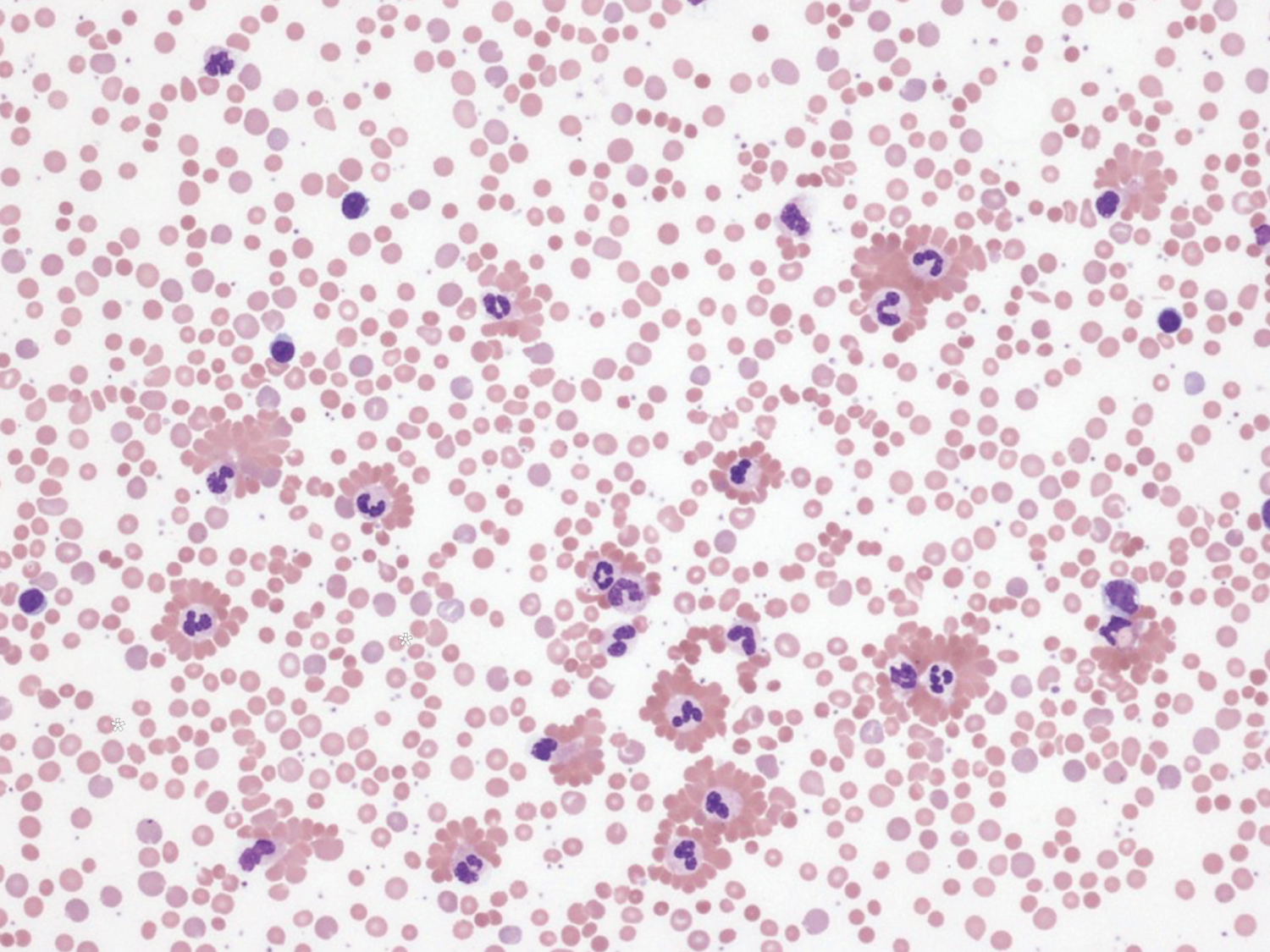 Cold agglutinin syndrome