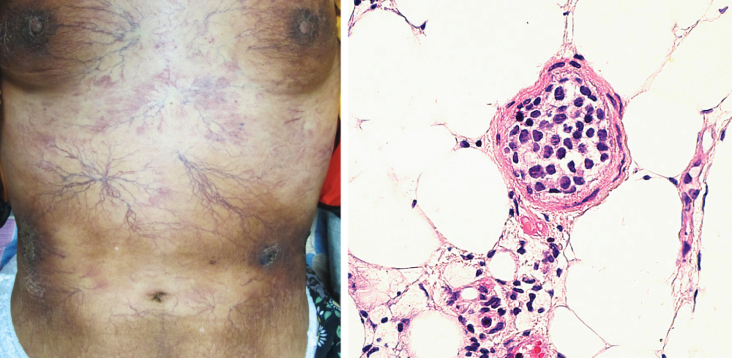 Intravascular lymphoma