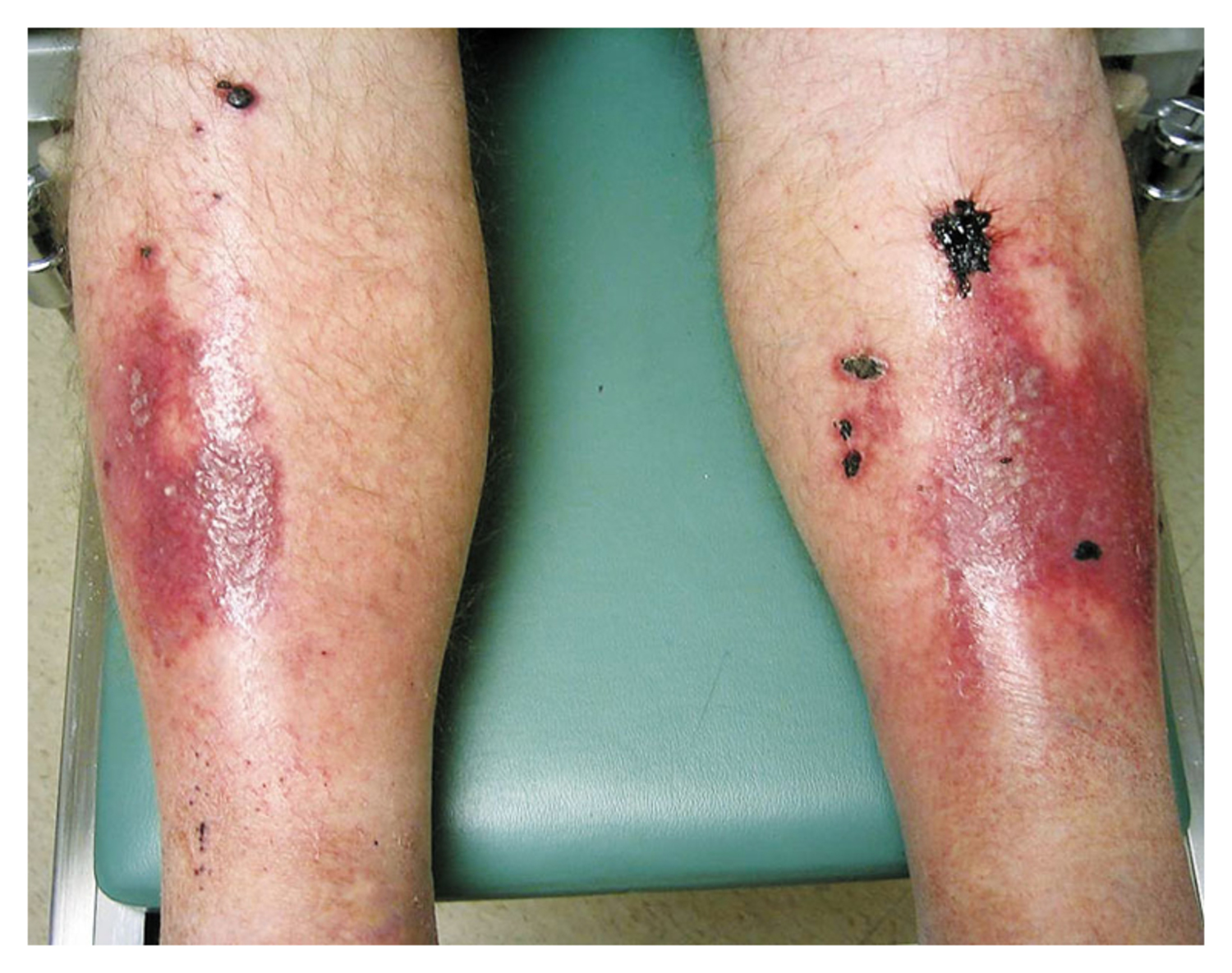 Necrobiosis lipoidica diabeticorum