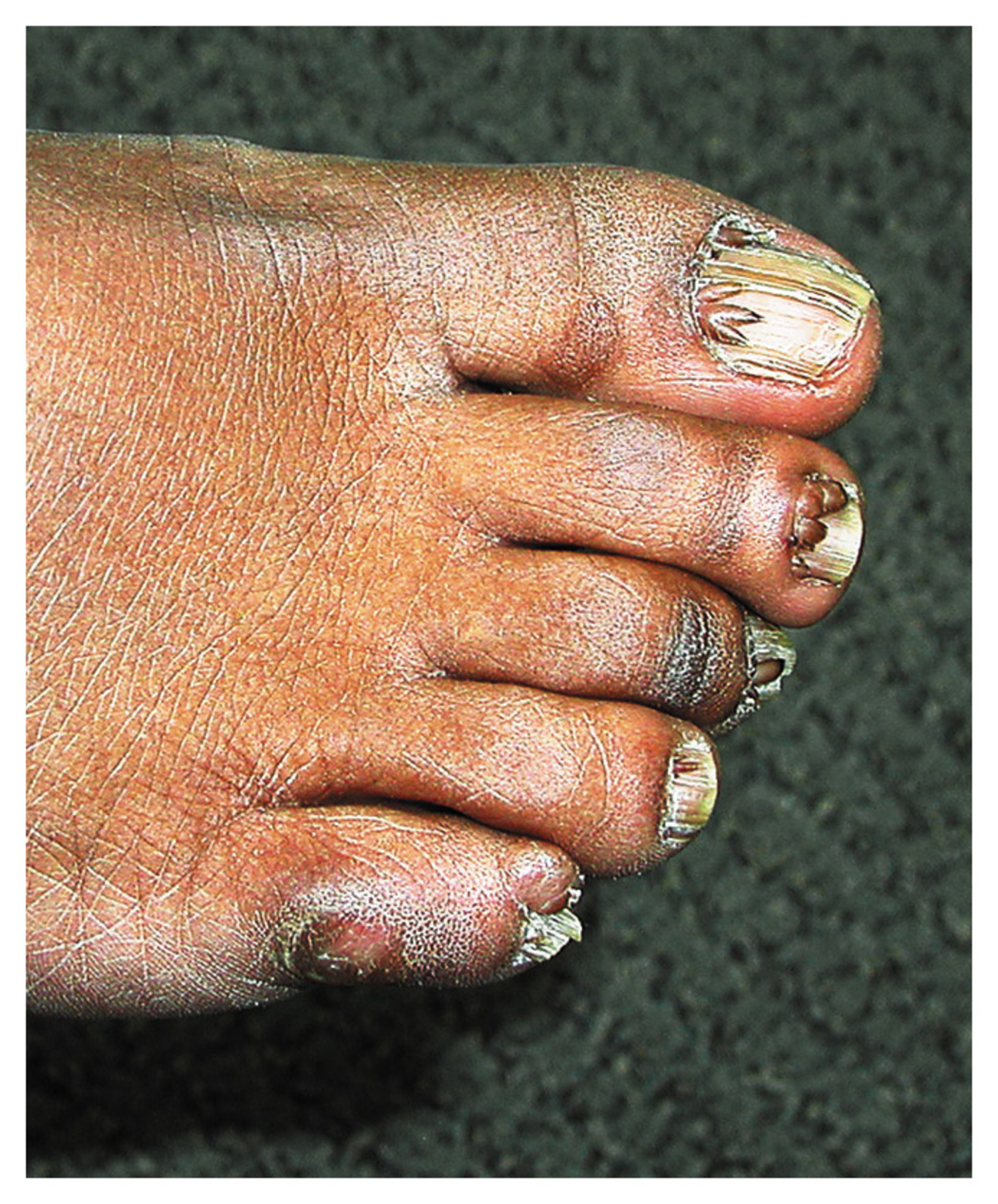 Tuberous sclerosis