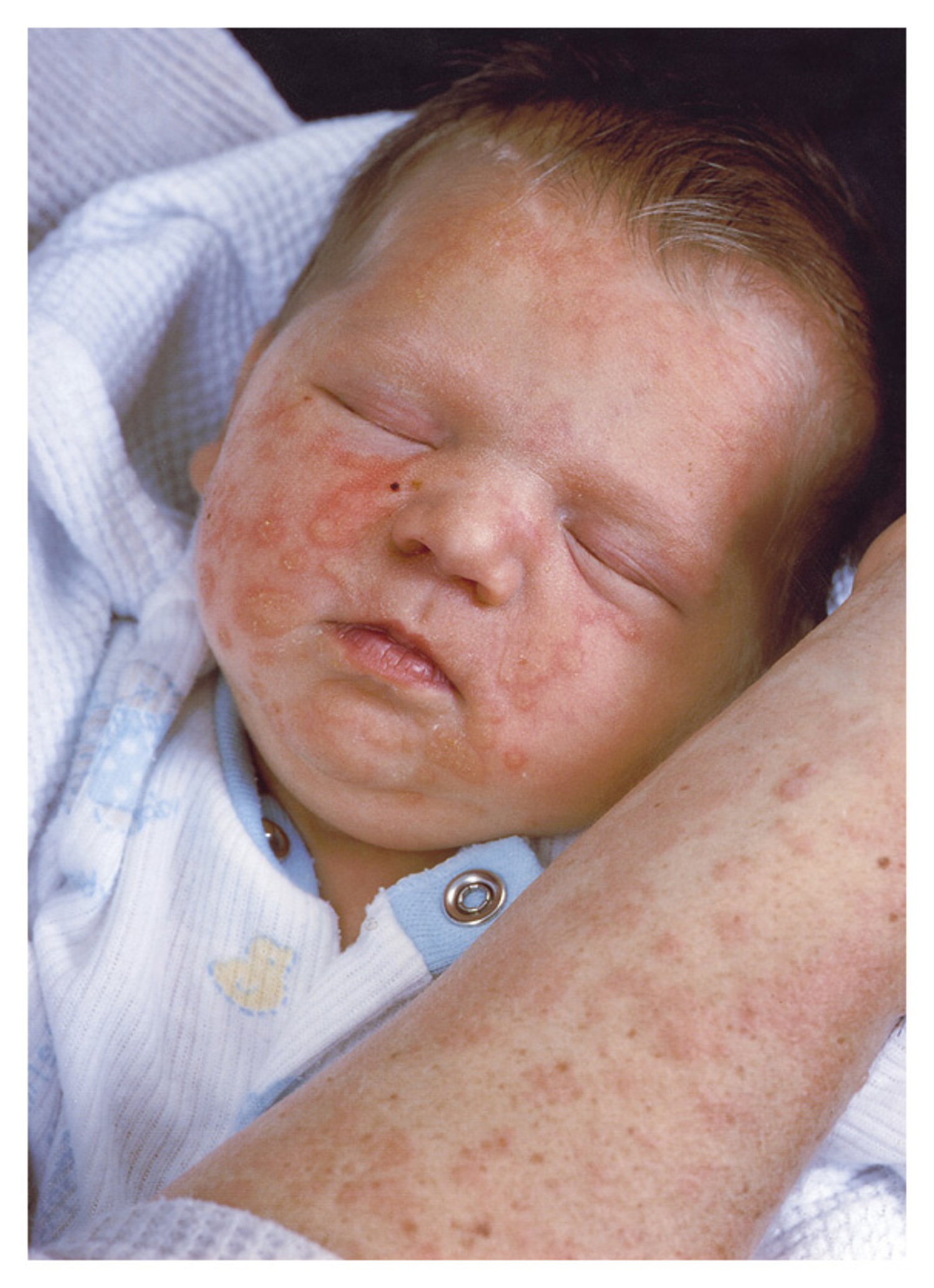 Herpes gestationis