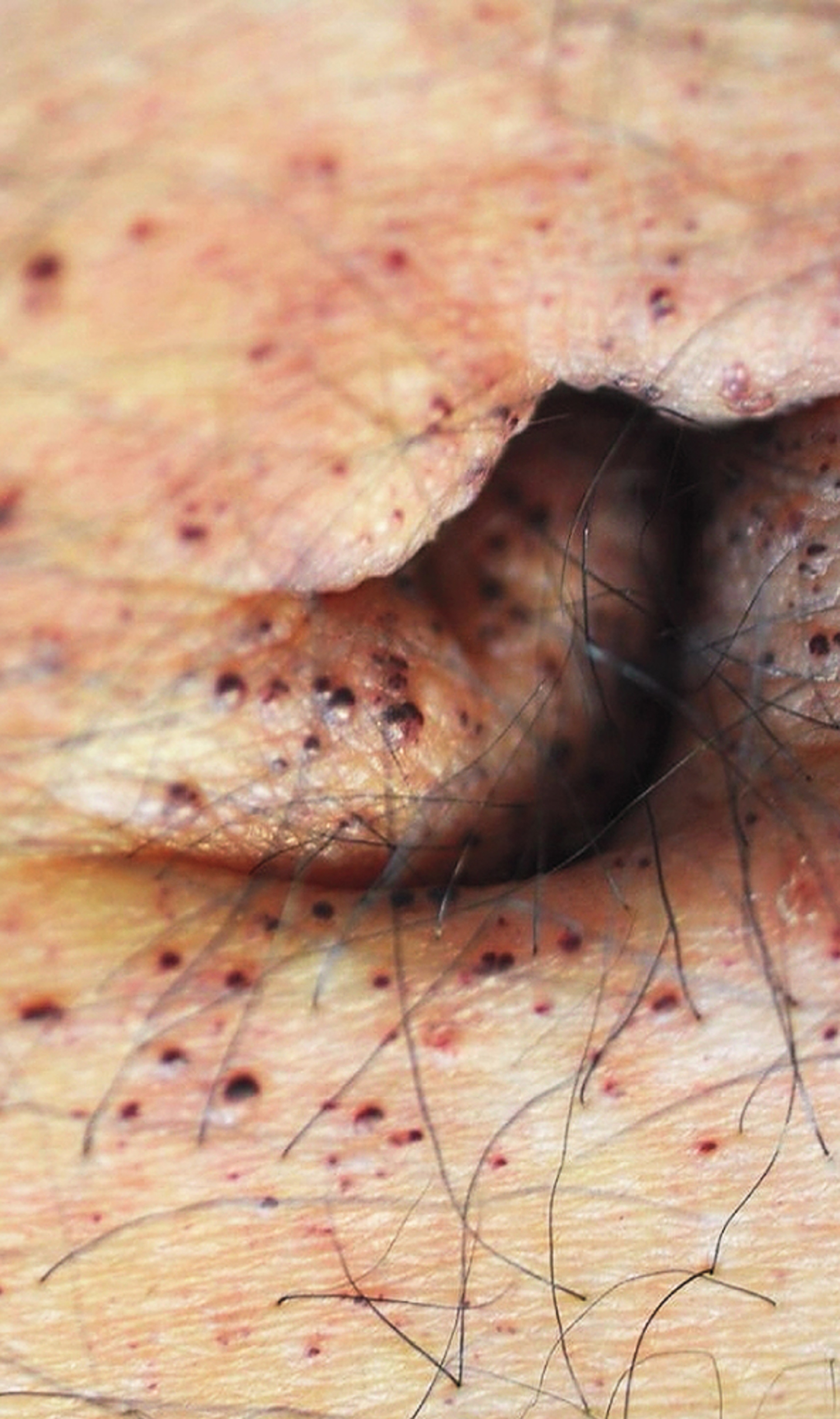 Fabry's disease