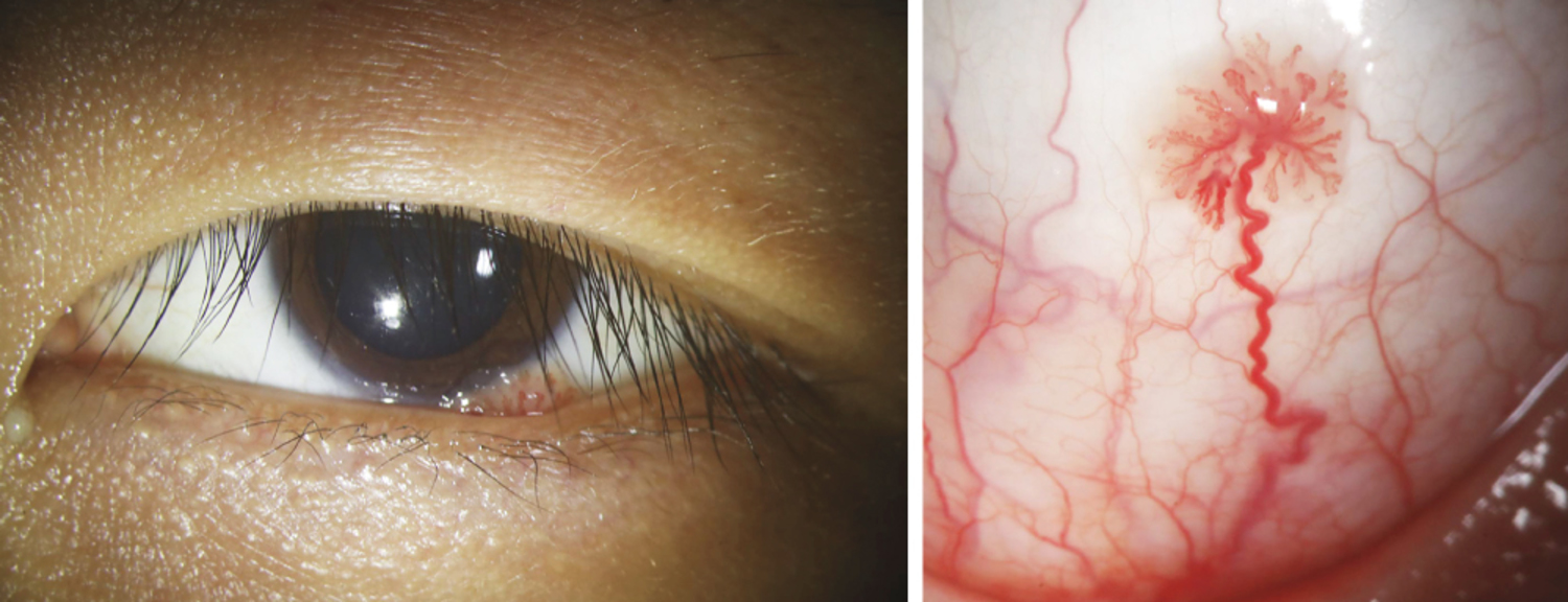 Conjunctival papilloma