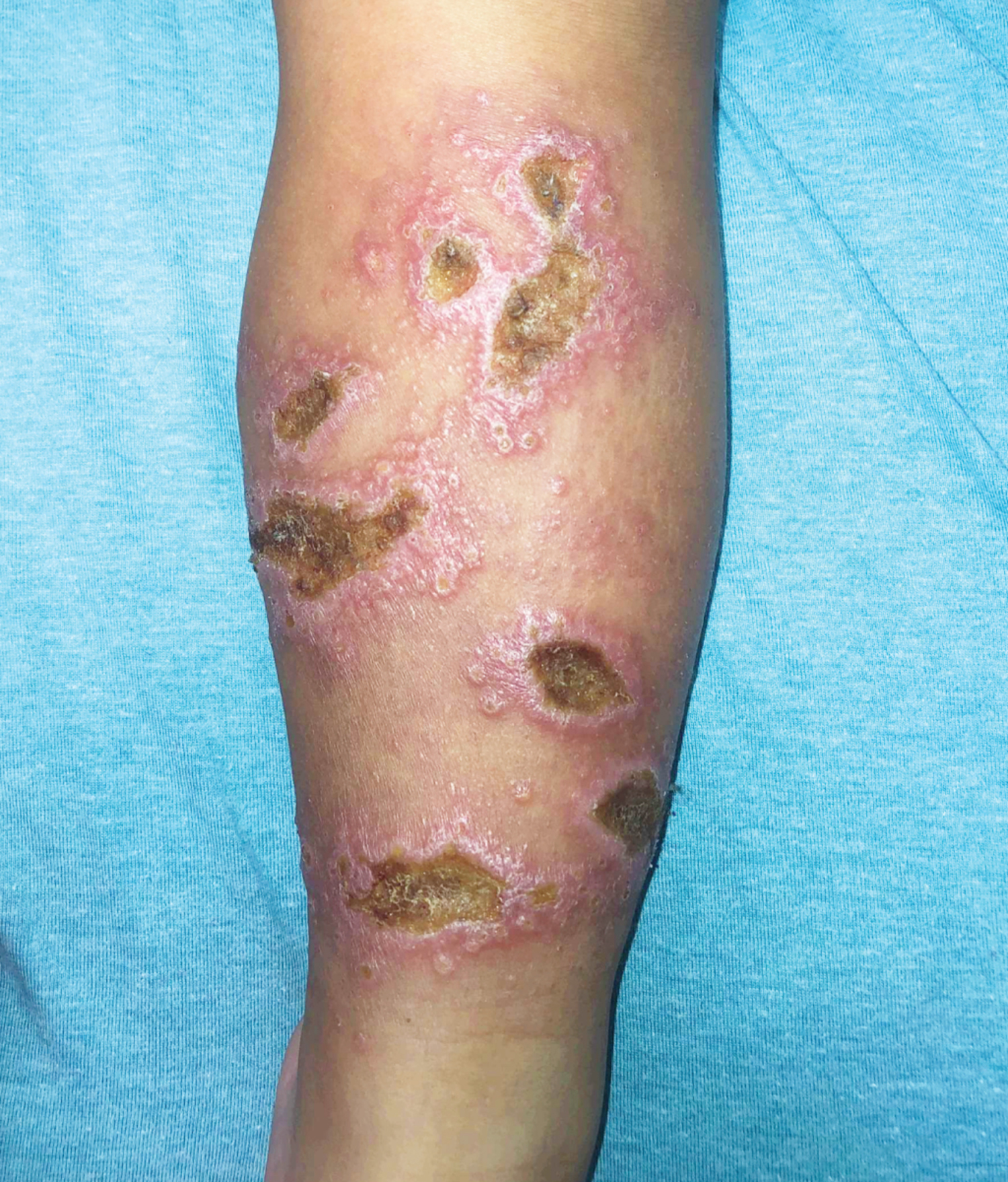 Cutaneous Leishmaniasis