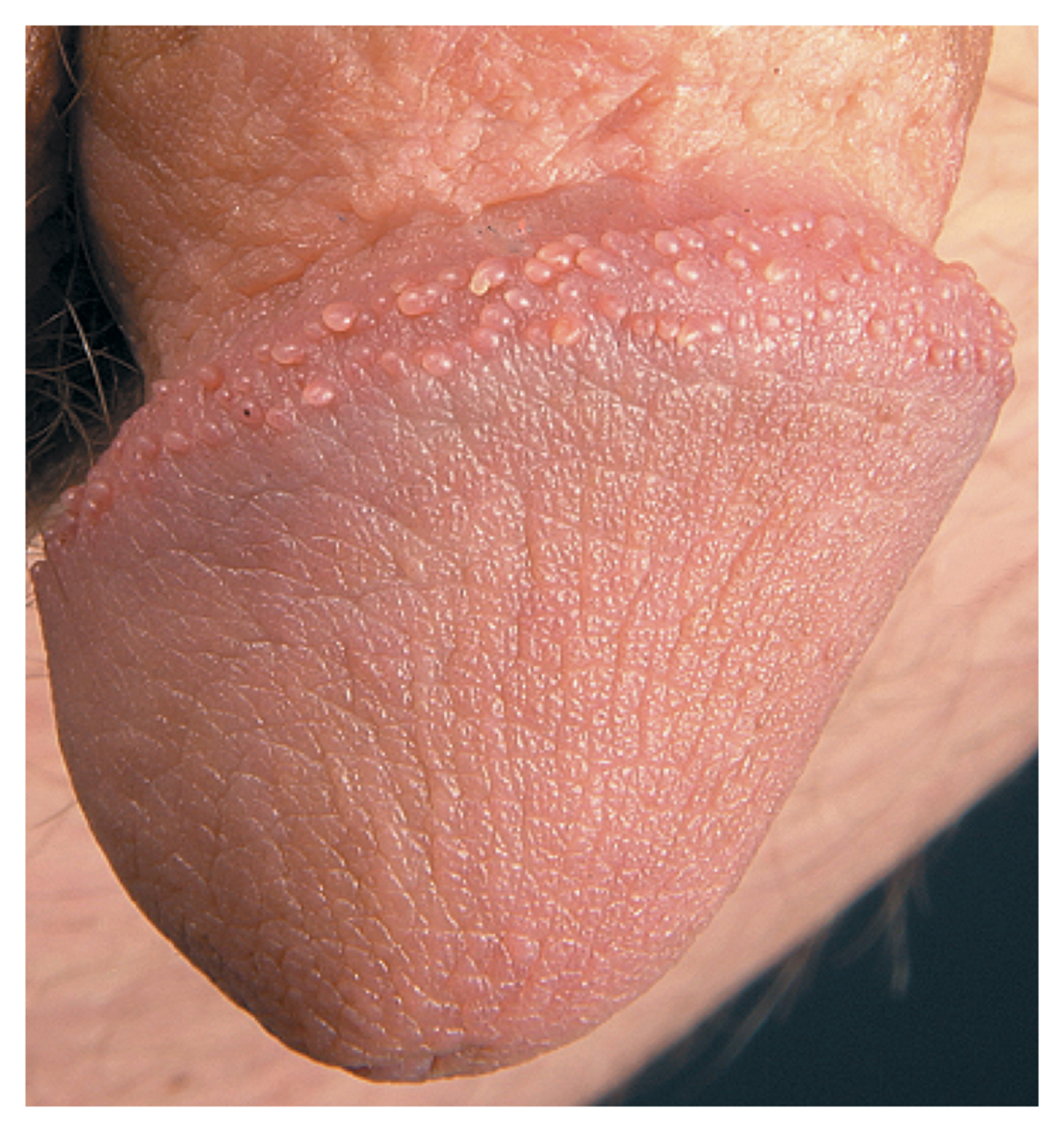 Pearly penile papules