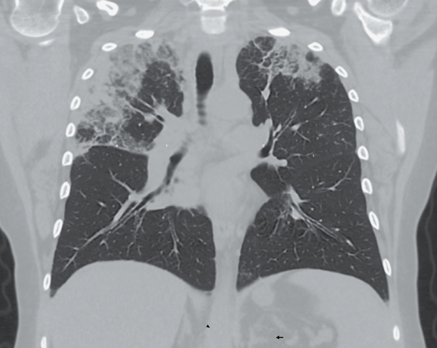 Chronic eosinophilic pneumonia