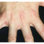 Scabies