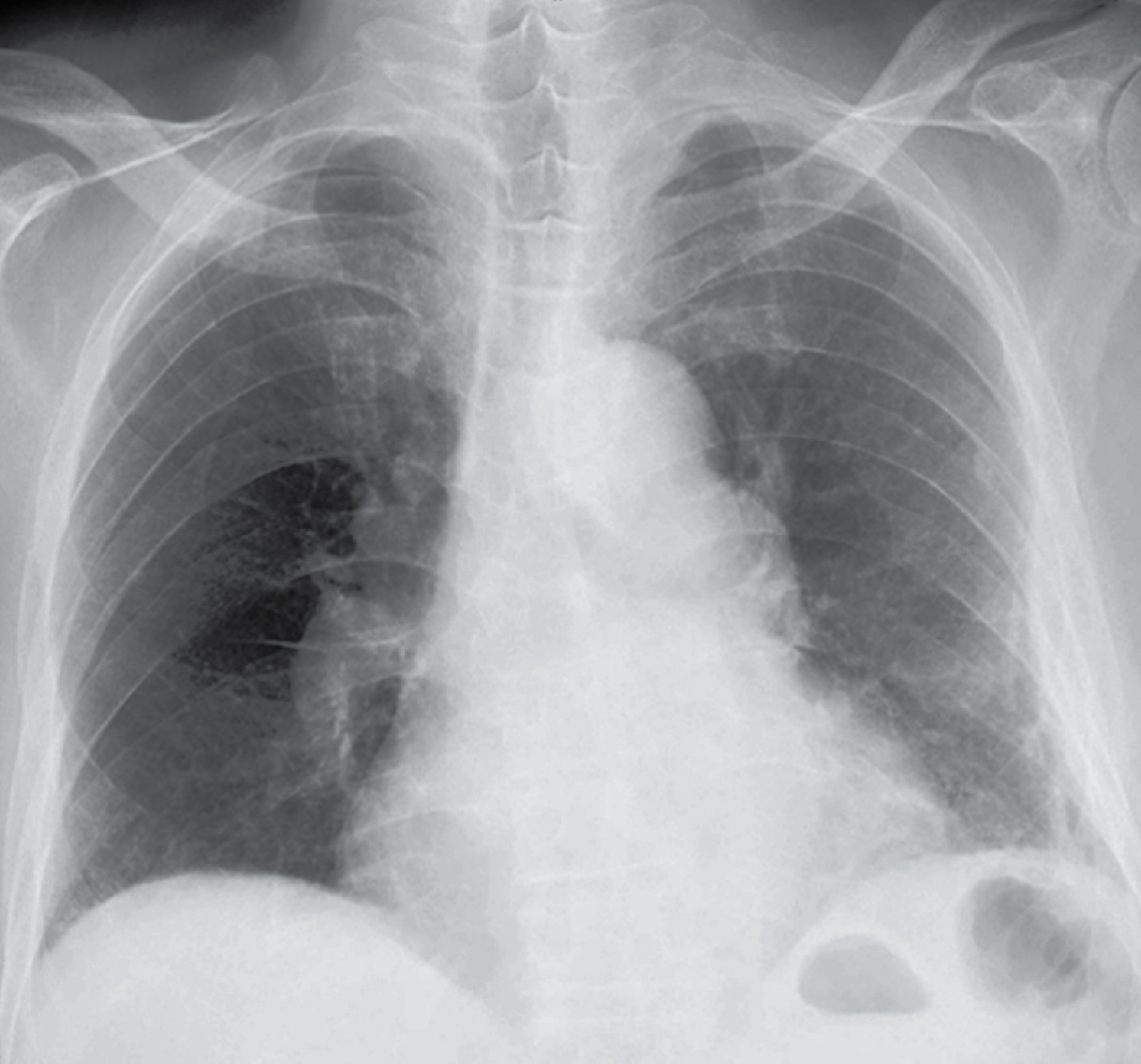 Pulmonary embolism