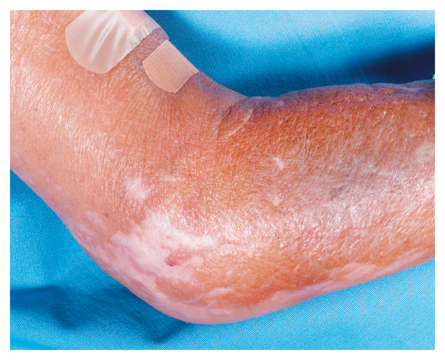 Nephrogenic fibrosing dermopathy