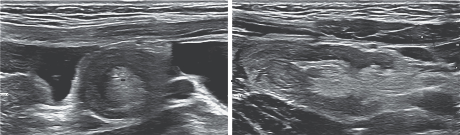 Ileoileal intussusception
