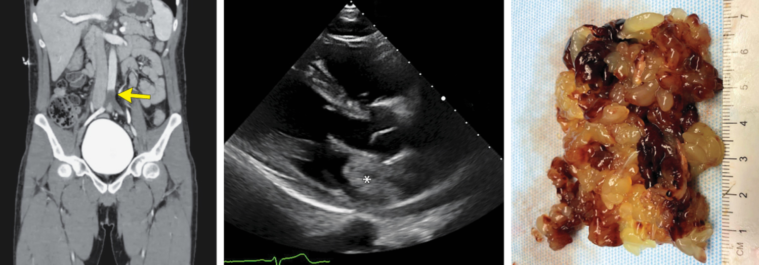 Cardiac myxoma