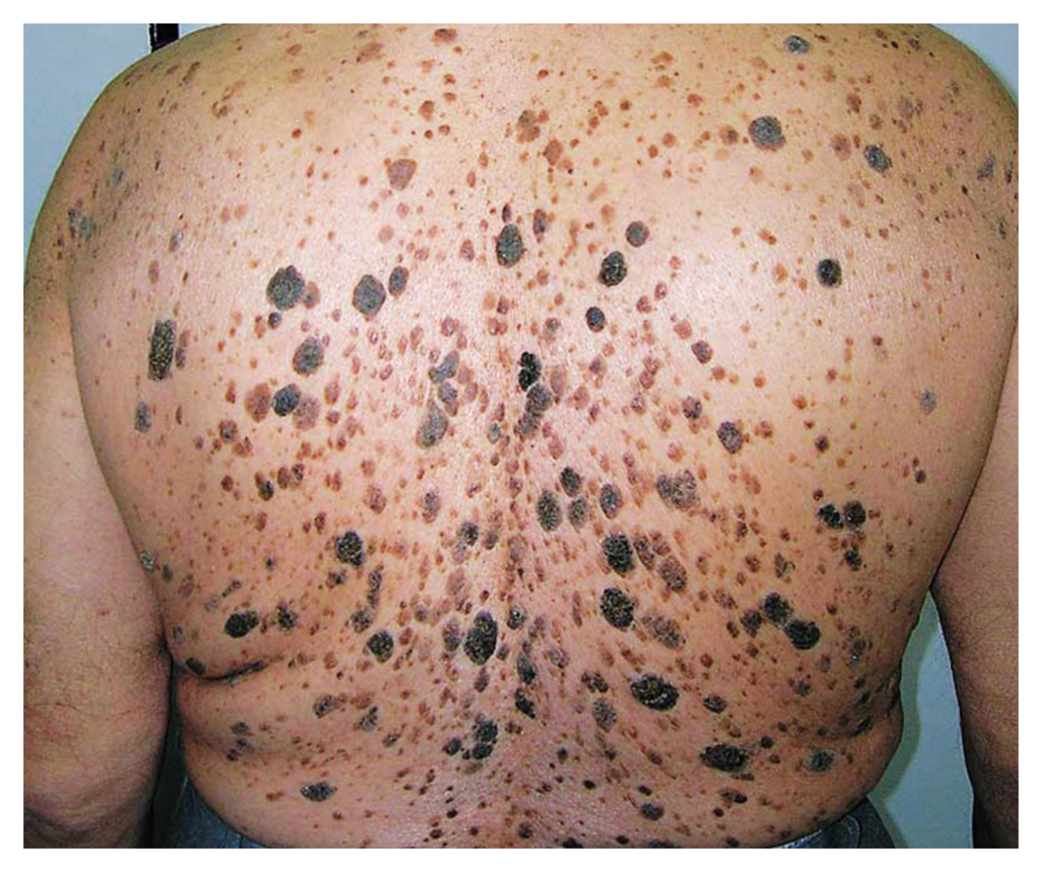 Seborrheic keratoses