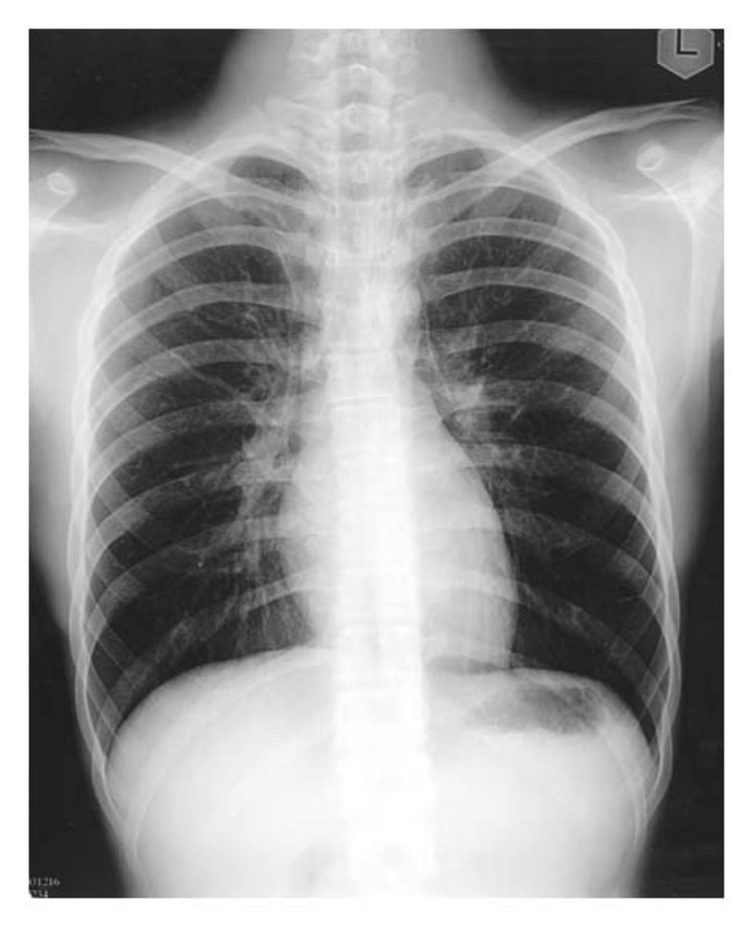 Pneumomediastinum