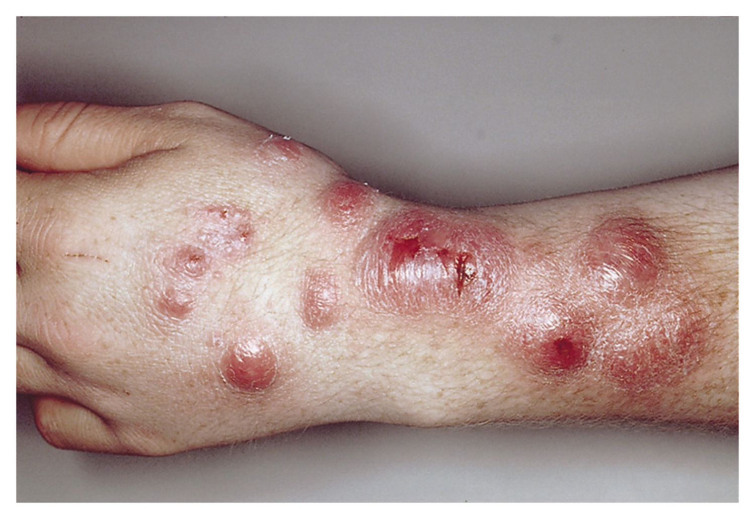 Mycobacterium marinum
