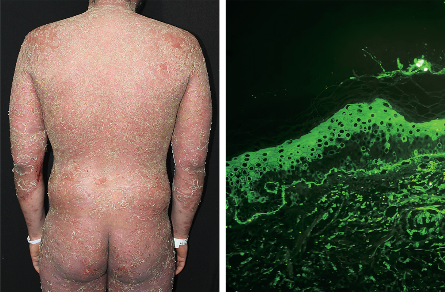 Pemphigus foliaceus