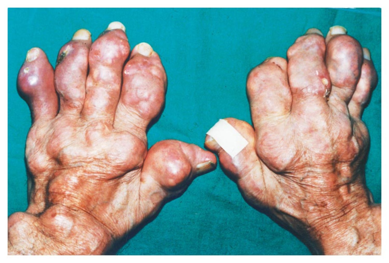 Gout