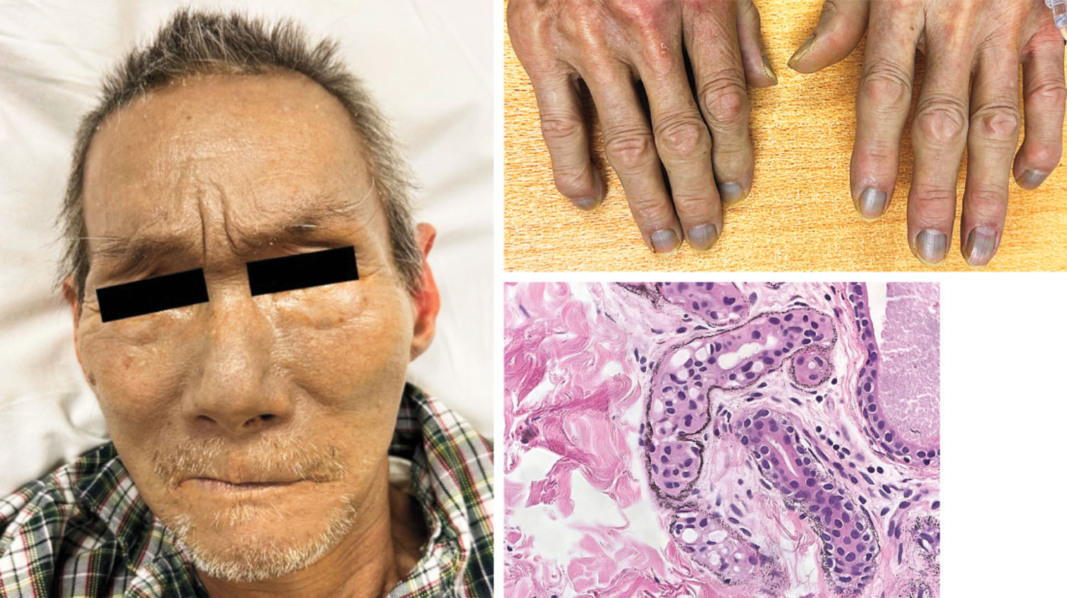 Argyria