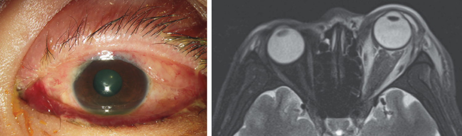 Vertical nystagmus