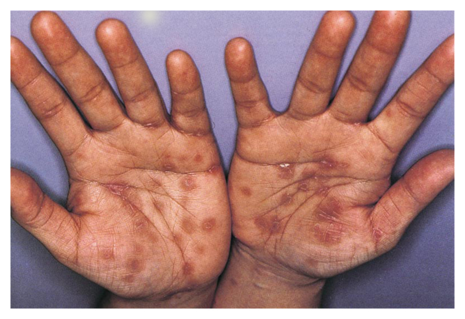 Secondary syphilis