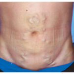Portal hypertension