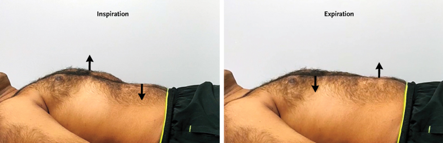 Polysomnography