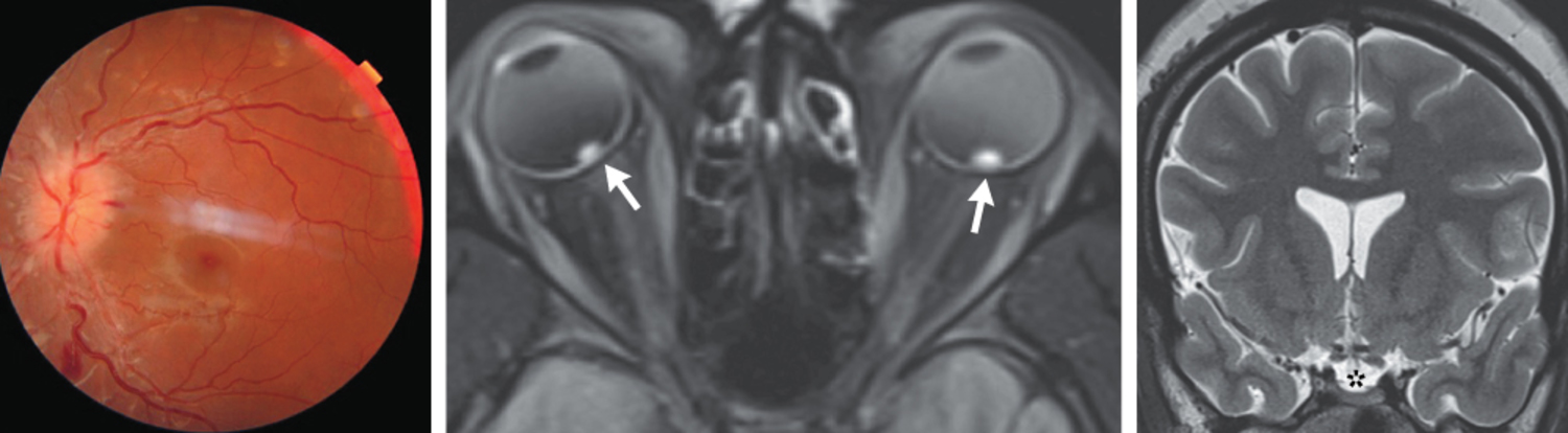 Elevated opening pressure