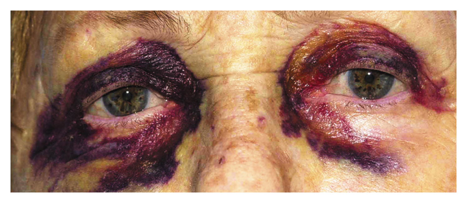 Amyloid purpura