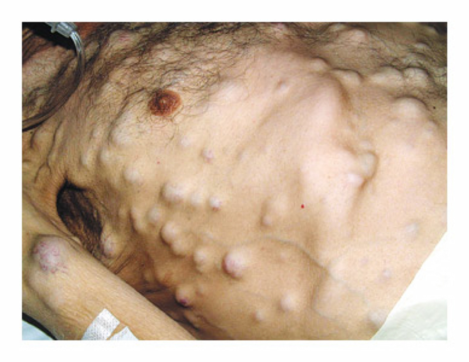 Small-cell lung cancer