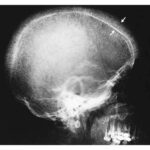 Bone marrow hyperplasia