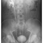 Right ureterovesical calculus