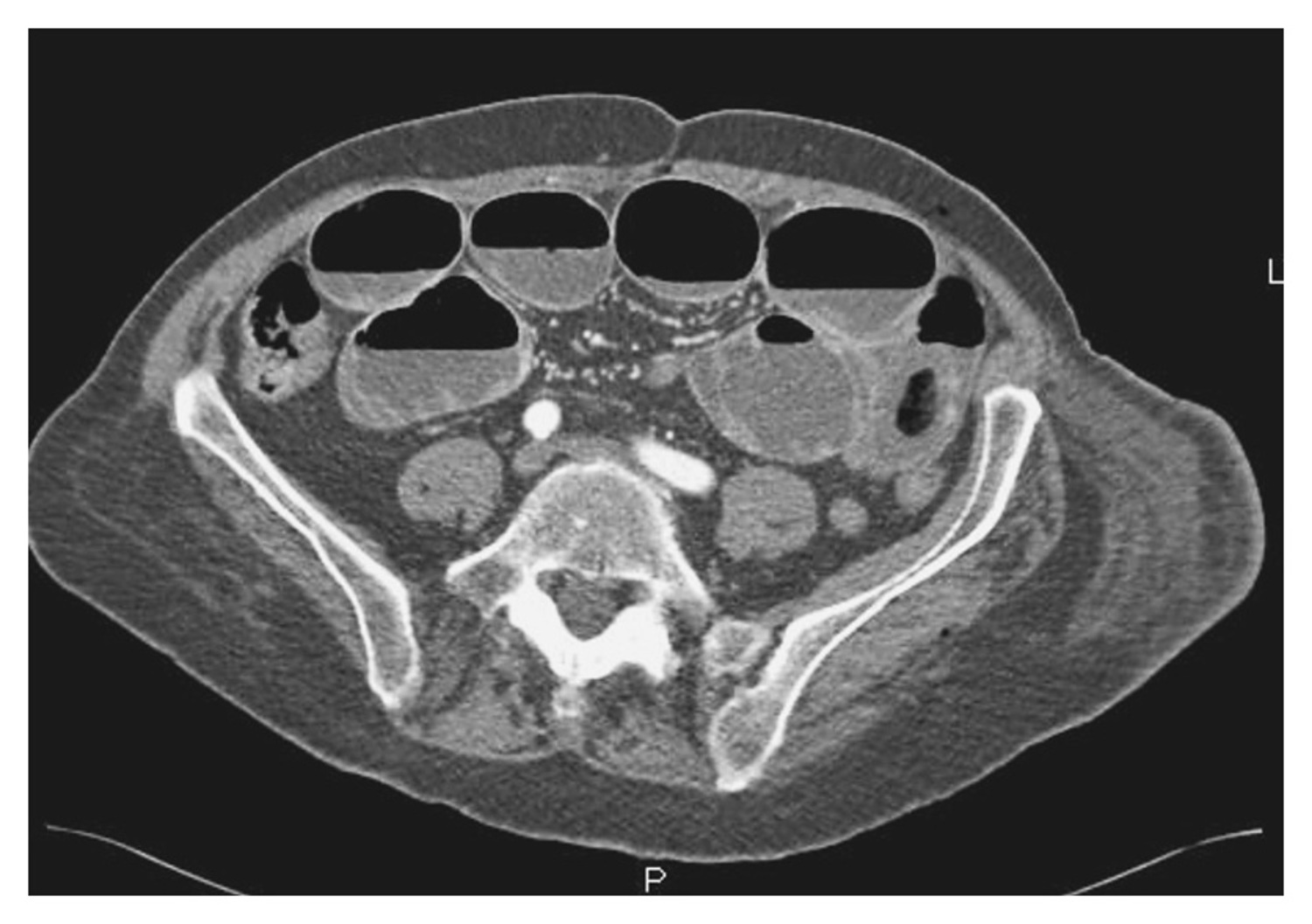 Small-bowel obstruction