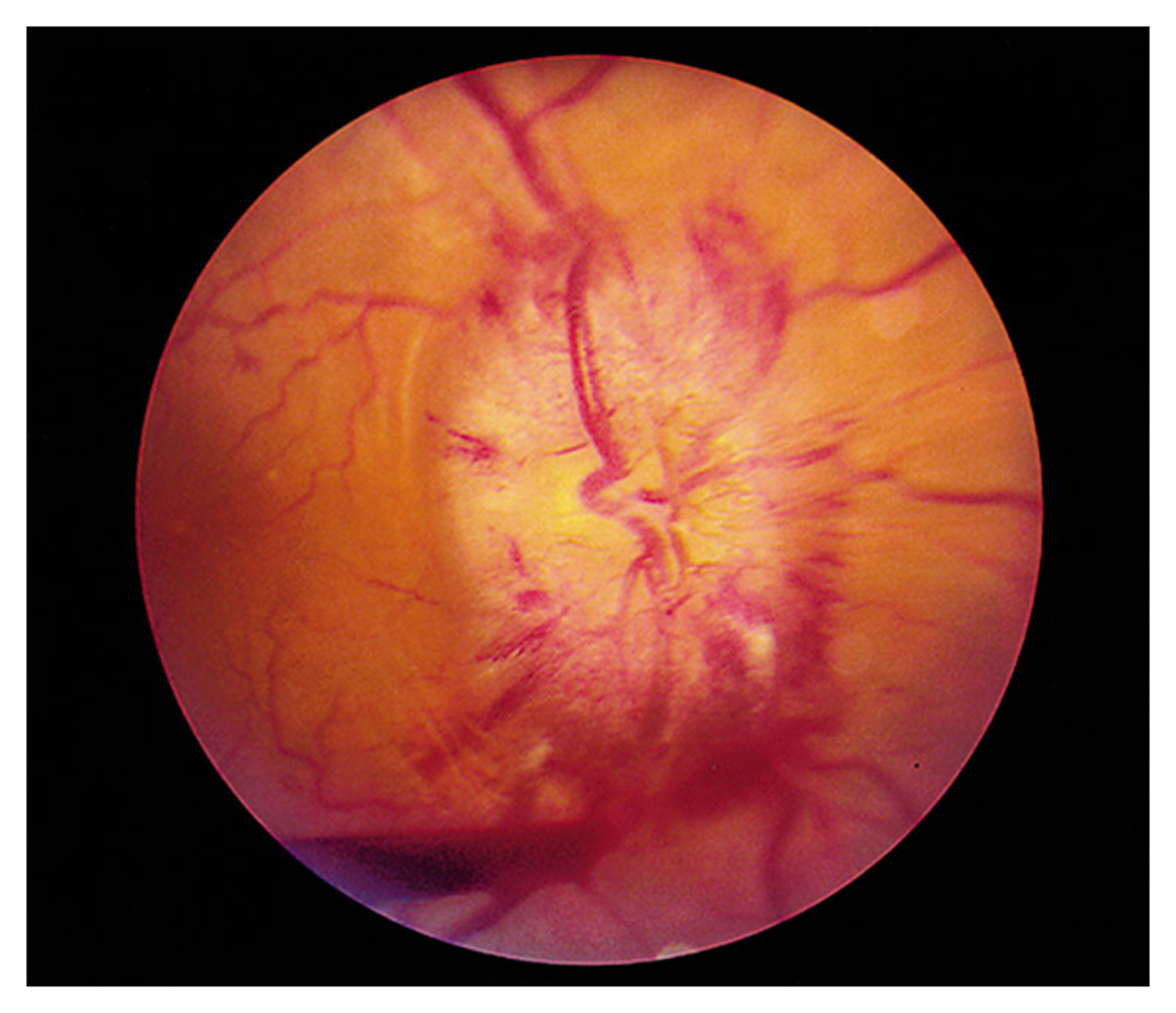 Papilledema