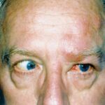 Herpes zoster ophthalmicus