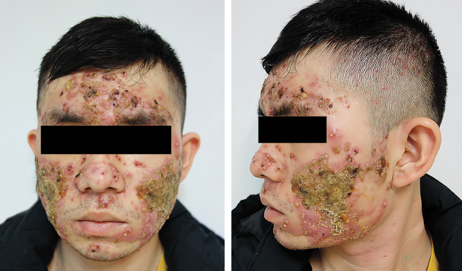 Acne fulminans