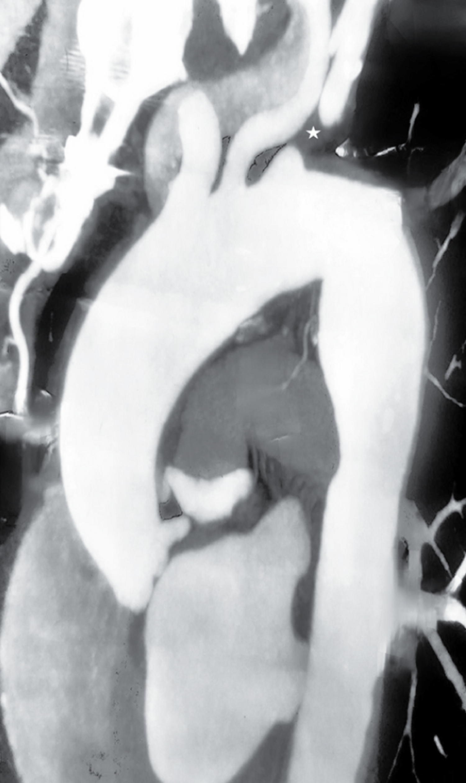 Coronary-Subclavian Steal Syndrome