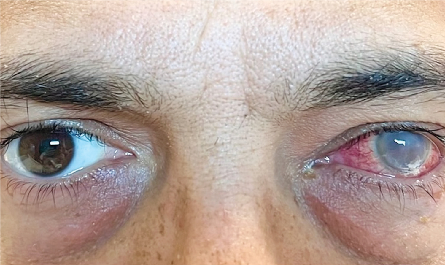 Intravitreal antimicrobial injections