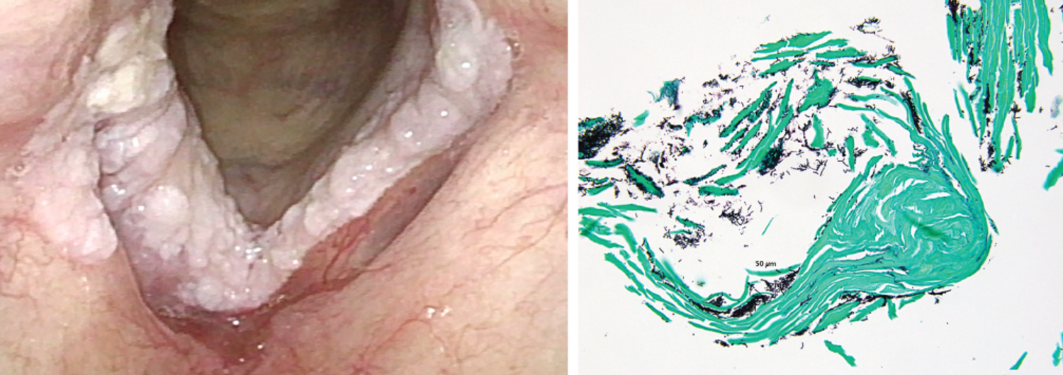 Laryngeal candidiasis