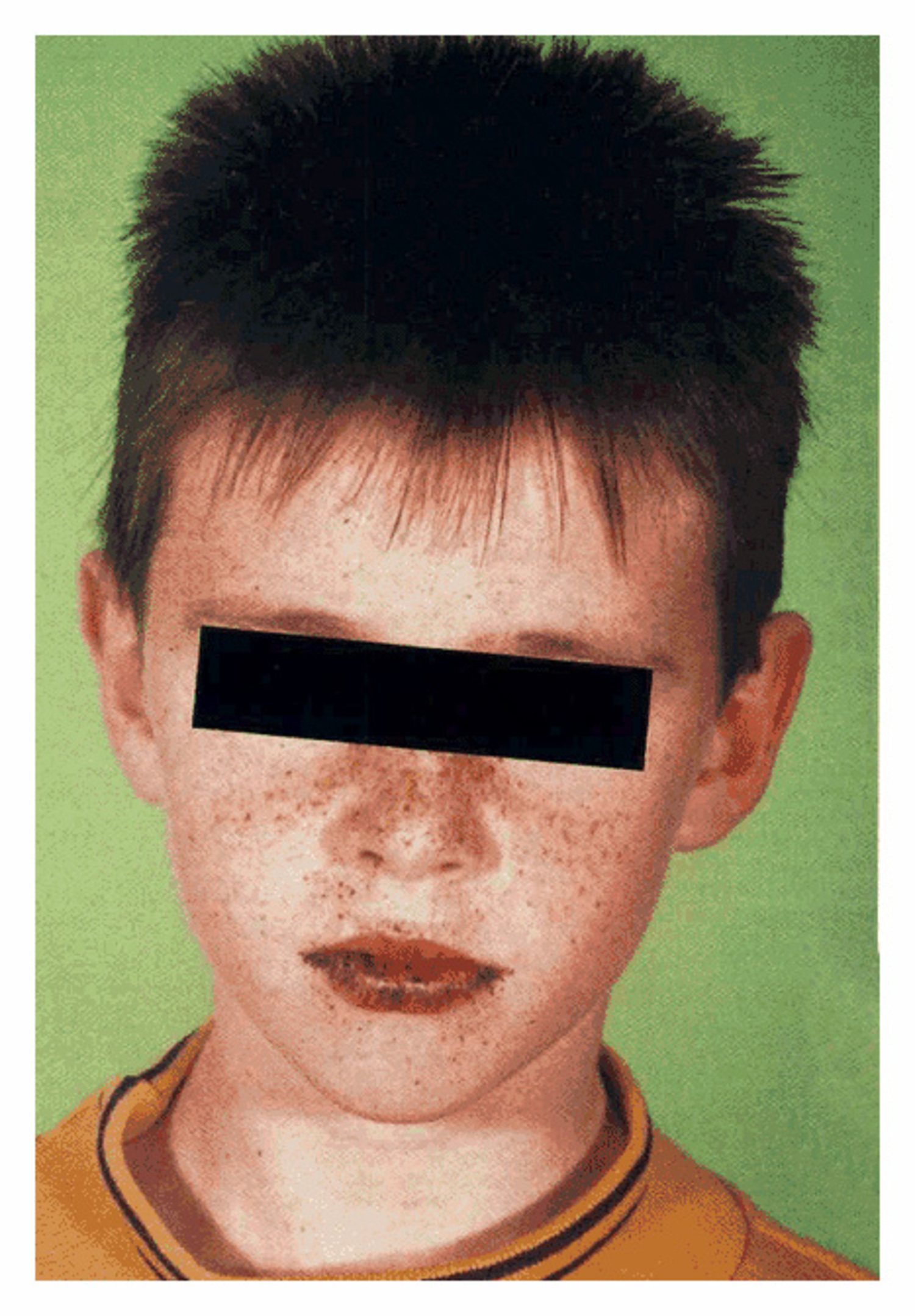 Peutz-Jegher's syndrome