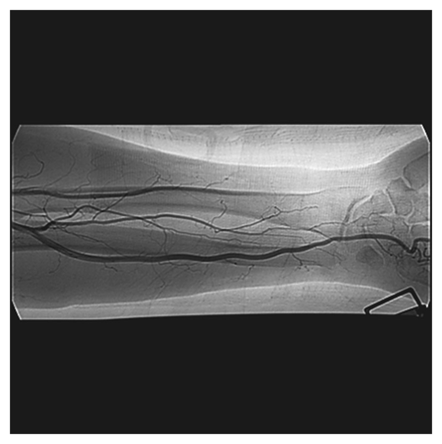 Radial artery thrombosis