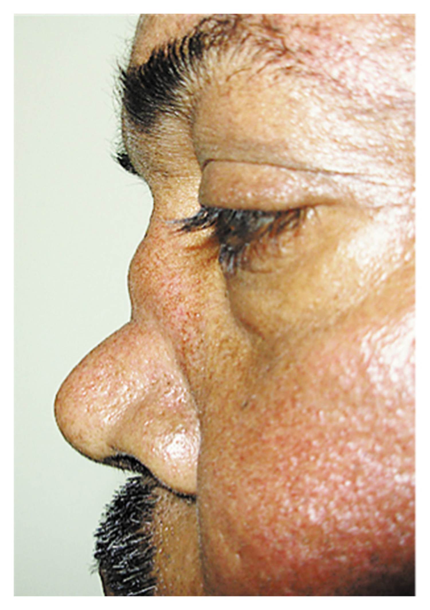 Wegener's granulomatosis