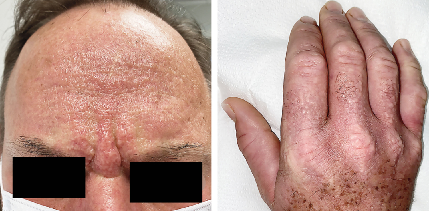 Scleromyxedema