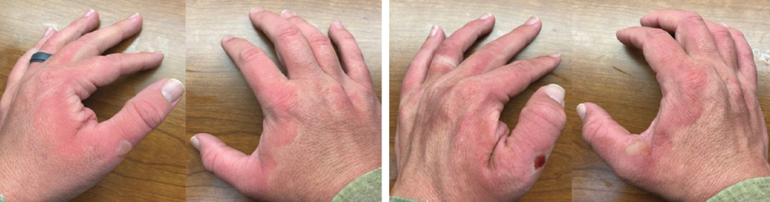 Phytophotodermatitis