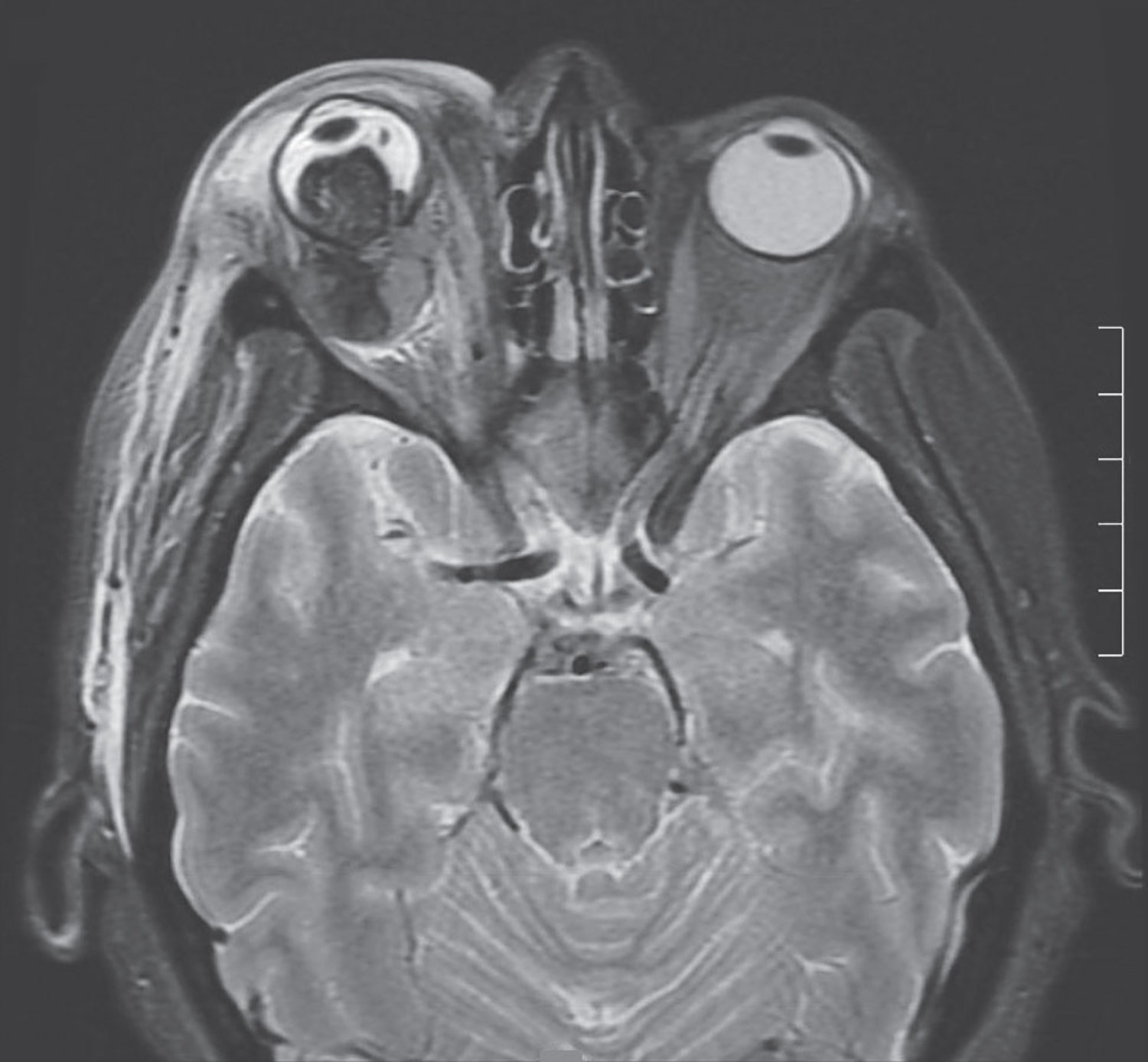 Uveal melanoma