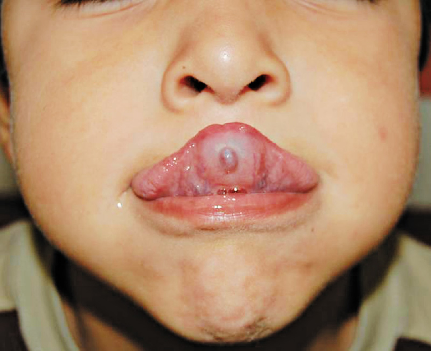 Mucocele