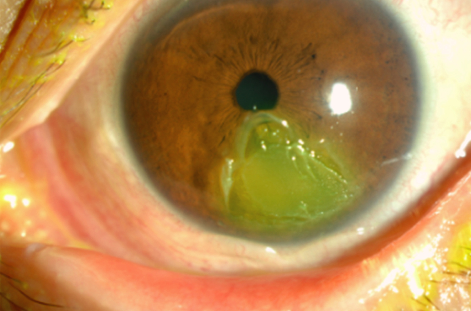 Autoimmune keratitis
