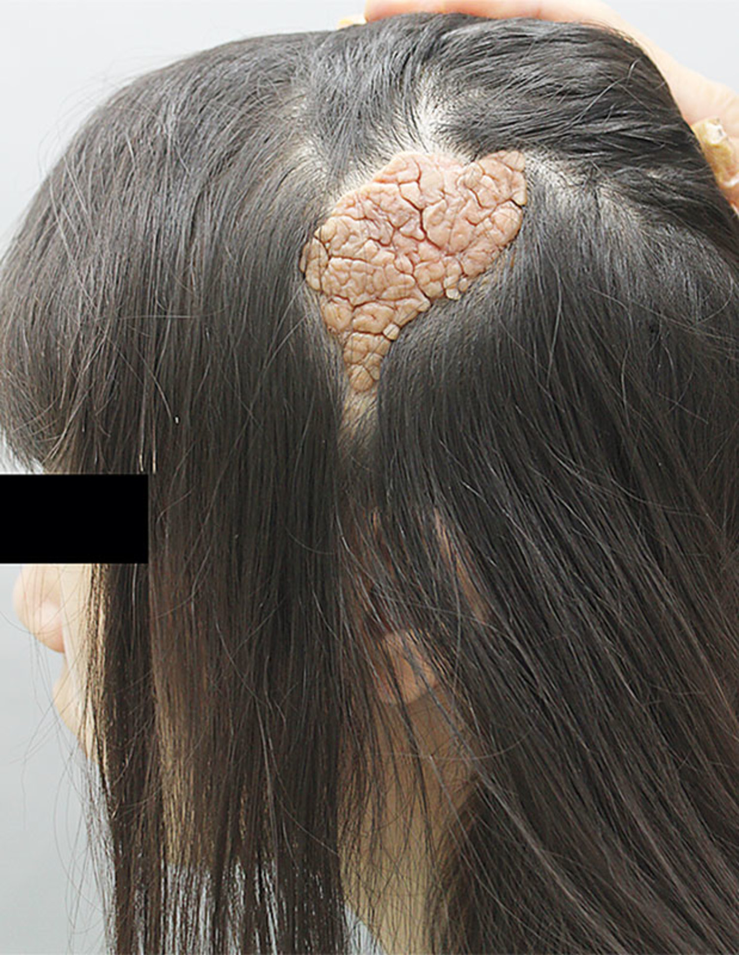 Cerebriform nevus sebaceous